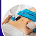 A Beginner's Guide to Tumescent Liposuction in Los Angeles