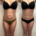 Removing Stubborn Fat Deposits: A Guide to Liposuction in Los Angeles
